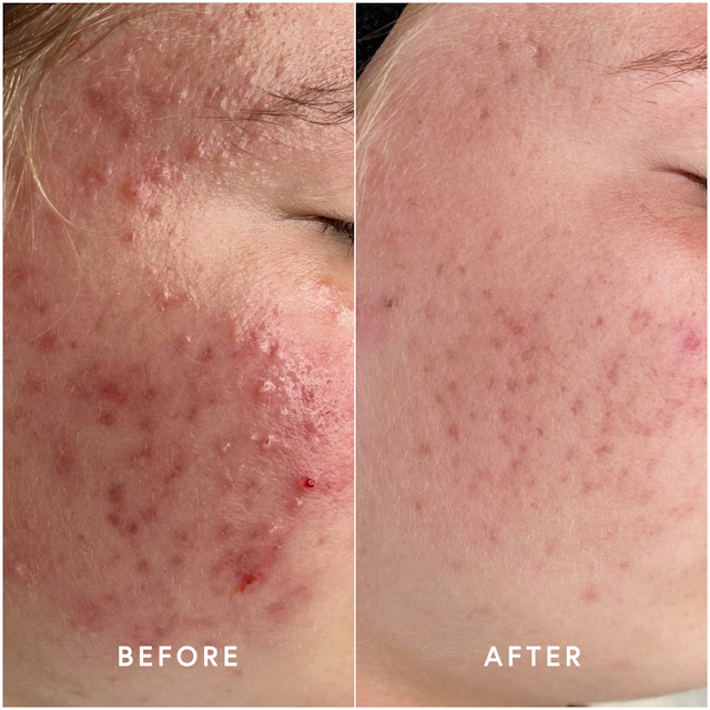 Picture of progress using Epicutis products