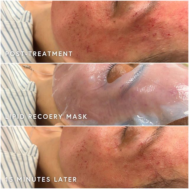Picture of progress using Epicutis products